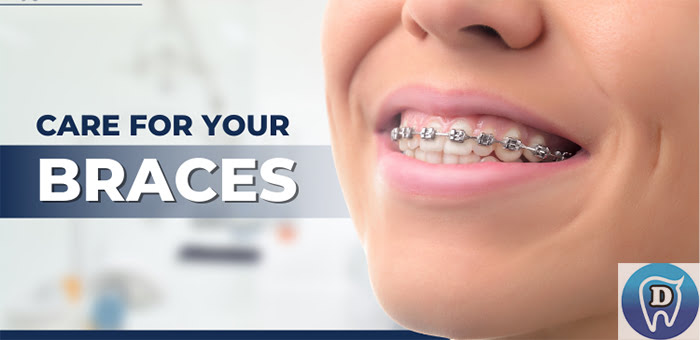 How to Take Care of Your Braces